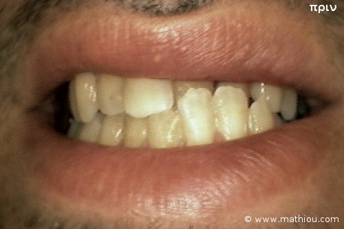 Περιστατικό Αισθητικής Οδοντιατρικής - Πριν vs Μετά