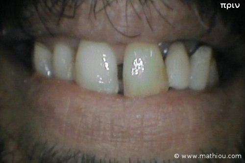 Περιστατικό Αισθητικής Οδοντιατρικής - Πριν vs Μετά