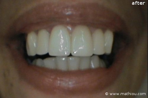 Cosmetic Dentistry - Before vs After