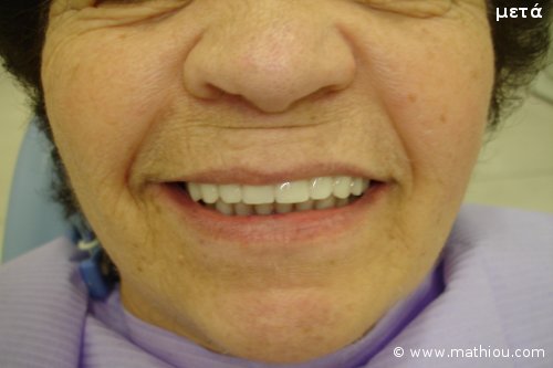 Οδοντικό Εμφύτευμα - Πριν vs Μετά