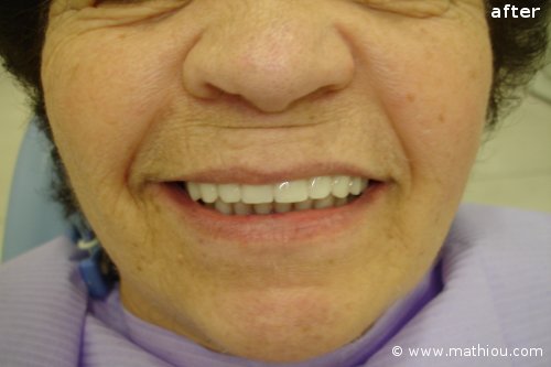 Dental Implant(s) - Before vs After