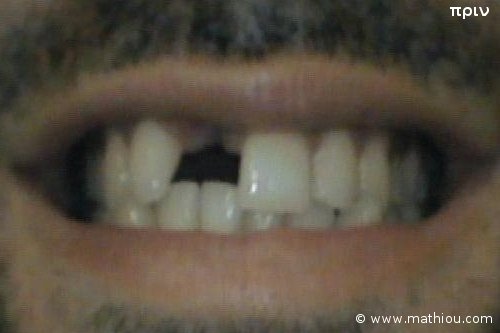 Οδοντικό Εμφύτευμα - Πριν vs Μετά