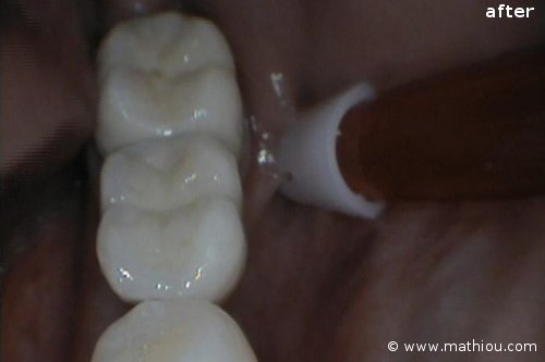 Dental Implant(s) - Before vs After
